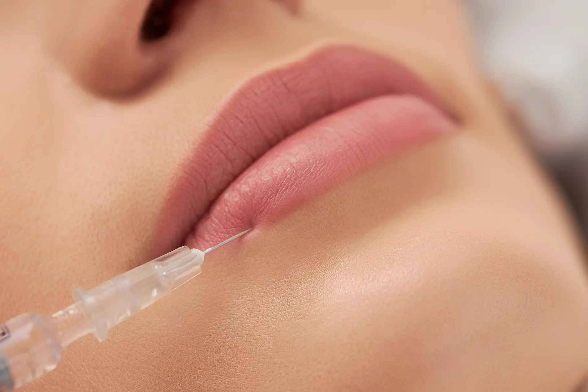 Relleno de Labios: Lo que Necesitas Saber sobre el Procedimiento y las Opciones Disponibles 3 Tratamiento de colágeno de labios a una chica